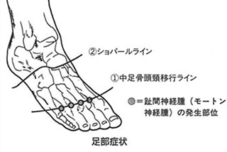 【連載】第5回 誤診しやすい足部症状について