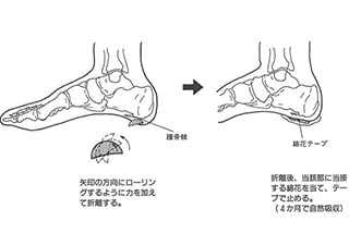 【連載】第6回 踵骨棘の保存的対処法
